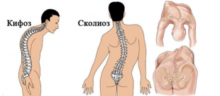 Нельзя при сколиозе!