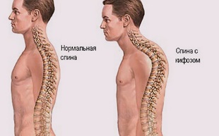 Упражнения для сутулой спины